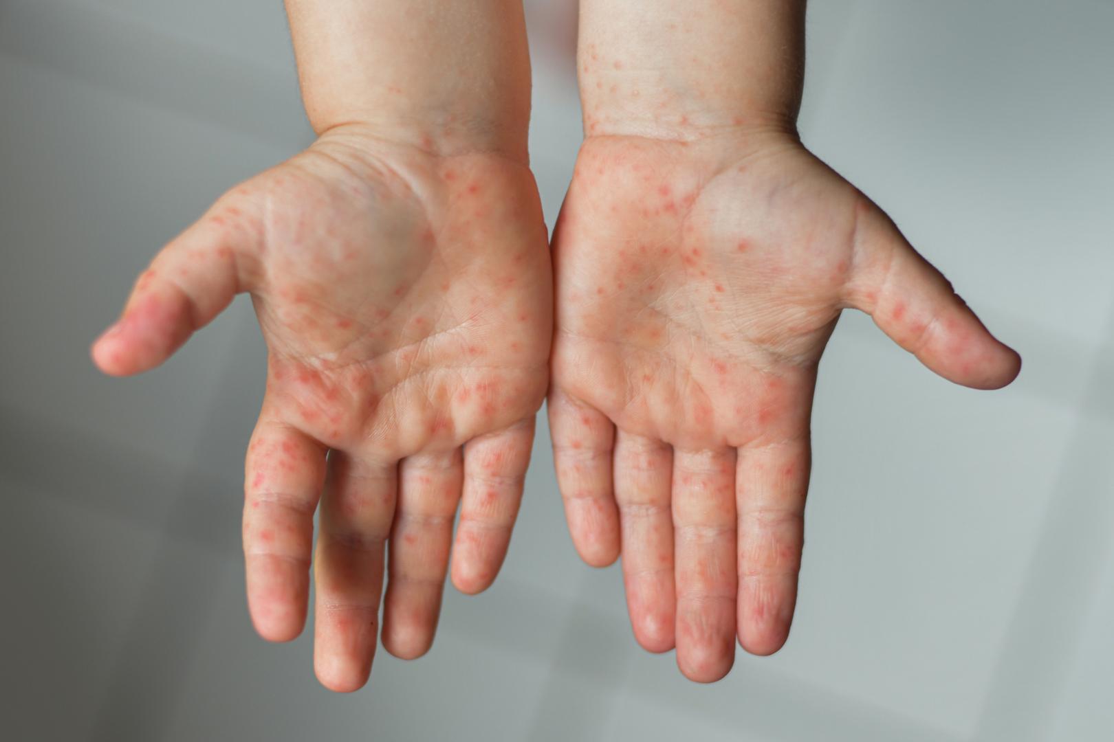 Kéz-láb-száj betegség: okok, tünetek, kezelés