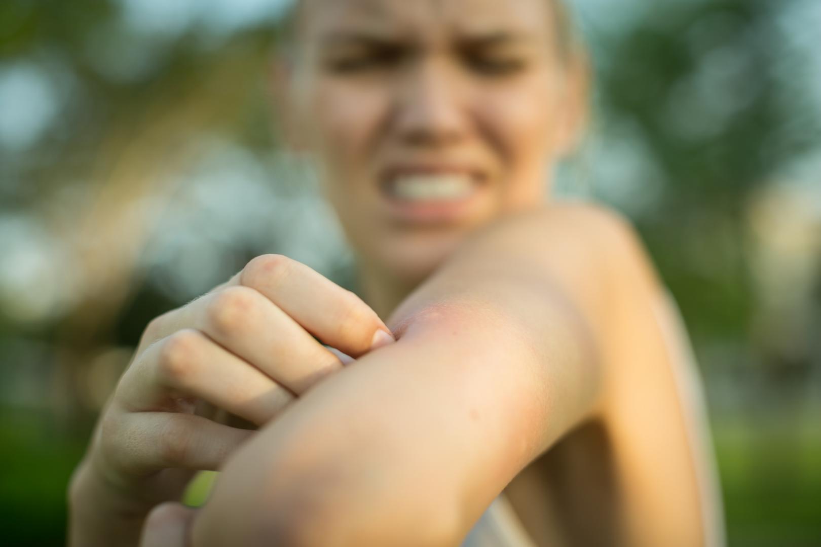 Eletveszelyes lehet a rovarcsipes allergia 16 9